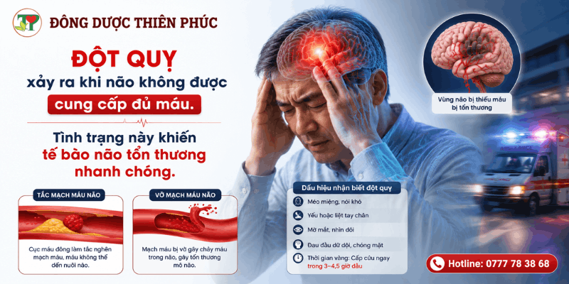 đột quỵ đột quỵ